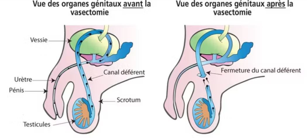 La vasectomie copyright focus.huffingtonpost.fr